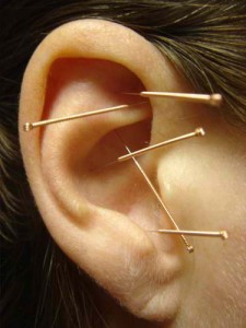 acupuncture to quit smoking